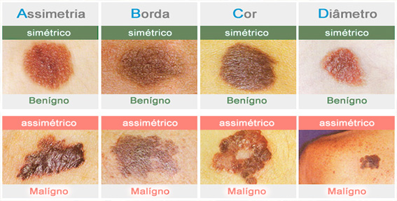 ABCD do Melanoma Câncer de pele - Dr. Rodrigo Pimenta